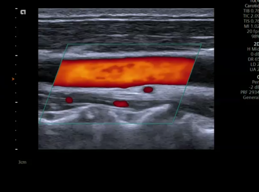 5 Color Doppler Imaging Of The Carotid Arteries 123 S 4519